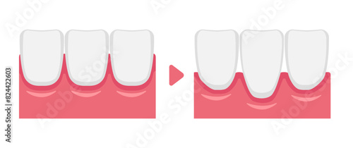 Vector illustration of healthy gums and gingival recession