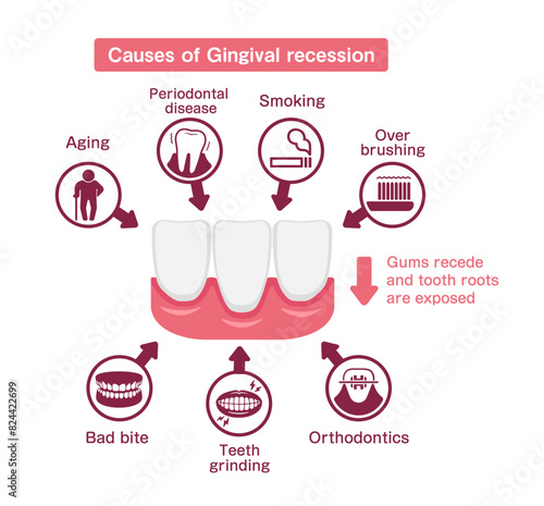 Causes of gingival recession. Vector illustration.