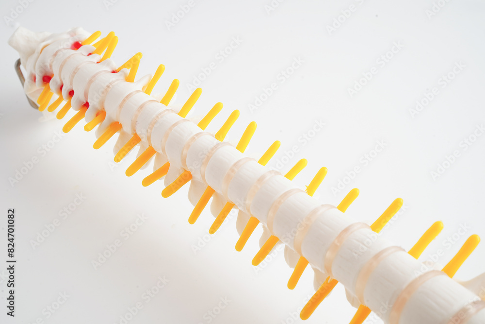 Spinal nerve and bone, Lumbar spine displaced herniated disc fragment, Model for treatment medical in the orthopedic department. Spinal nerve and bone, Lumbar spine displaced herniated disc fragment, Model for treatment medical in the orthopedic department.