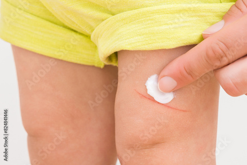 Young adult woman hand finger applying white medical ointment on abrasion leg skin of toddler. Isolated on light gray background. Mother giving first aid. Closeup. Front view. photo