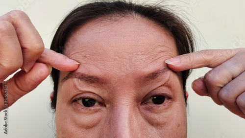 portrait the fingers holding the flabbiness adipose sagging skin, forehead lines and loose, Direct Brow Lifting, wrinkle and Flabby skin beside the eyelid, dark spots and blemish on the face.
