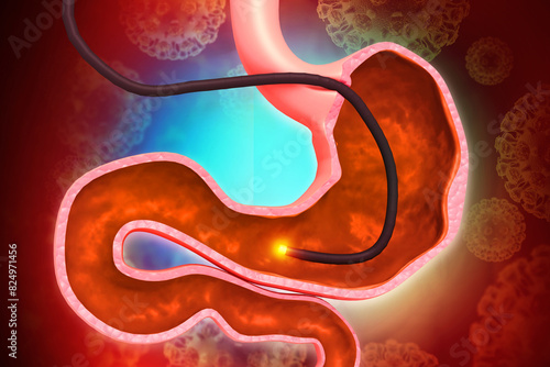 Human Stomach with endoscope and close-up view of bacterium Helicobacter pylori which causes ulcers, stomach ulcer or gastric ulcer, 3d illustration photo