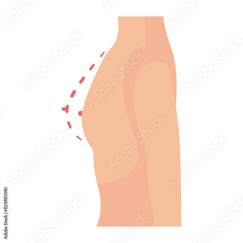Transaxillary Breast Augmentation concept, Scarless implant Plastic Surgery vector flat design, plastic surgeon Symbol,  body contouring Sign, Beauty treatment stock illustration