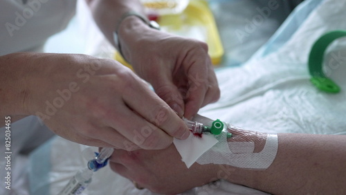 Nurse hand applying medical drip into Patient s hand with IV catheter closeup. hospital equipment and routine