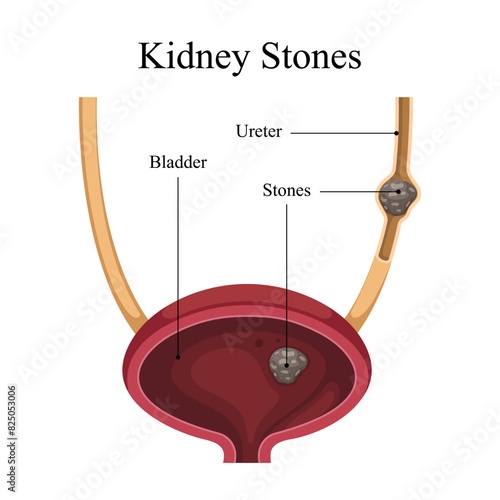 internal organ vector diagram of kidney stone disease