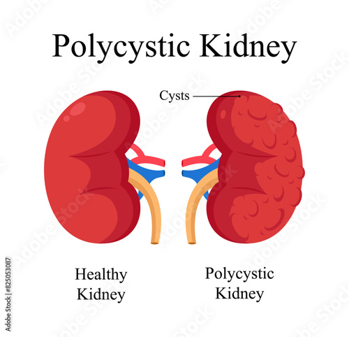 human polycystic kidney diagram photo