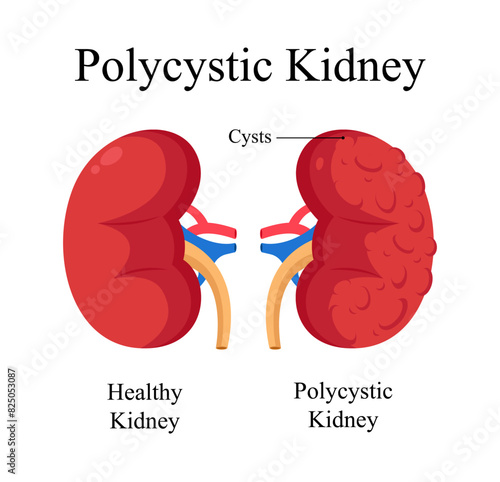 human polycystic kidney diagram