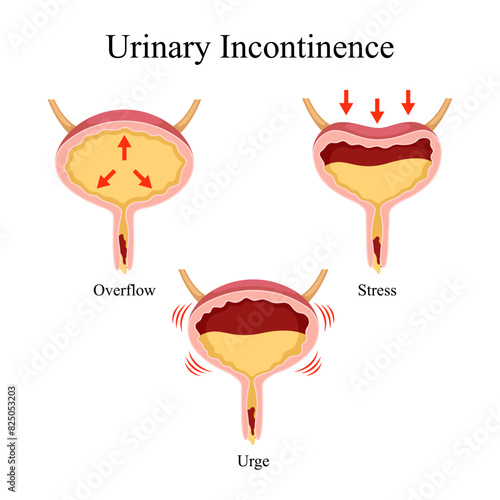 human urinary incontinence design vector