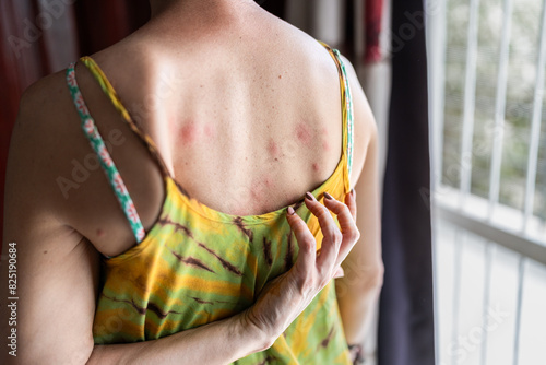 Woman Suffering From Bed Bug Bites in Africa photo