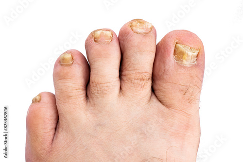 Toes damaged by nail fungus.