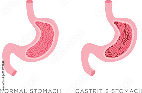 Comparison of healthy and inflamed stomachs in a vector illustration