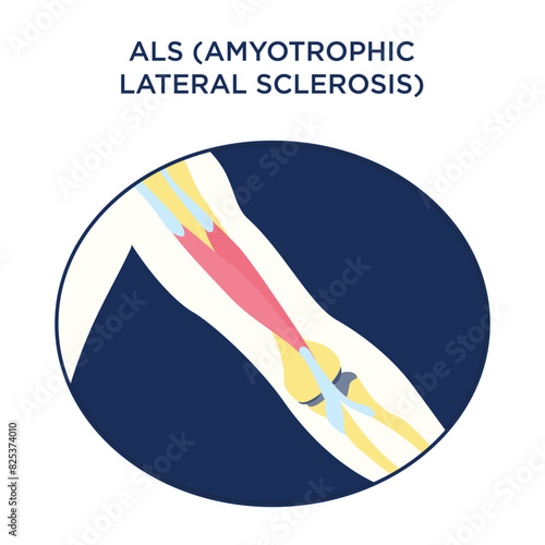 Vector icon for the nervous system disease ALS (Amyotrophic Lateral Sclerosis)