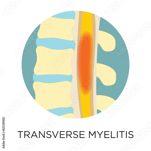 Transverse myelitis flat style vector illustration in circle layout with type, medical infographic