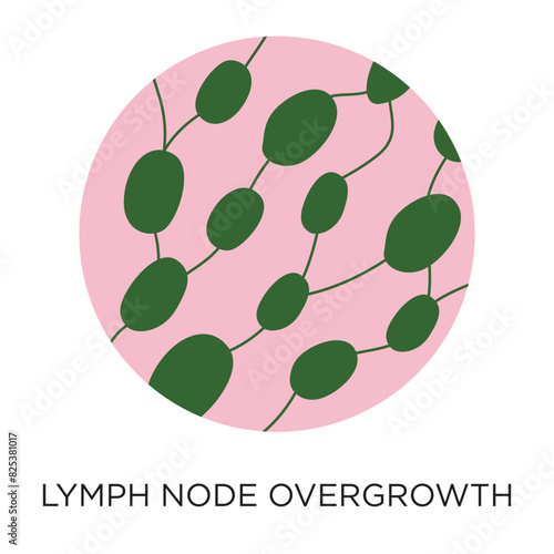 Lymph node overgrowth flat style vector illustration