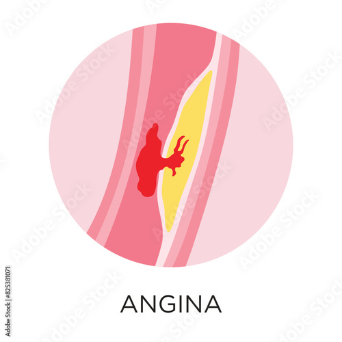 Angina heart disease flat style vector illustration