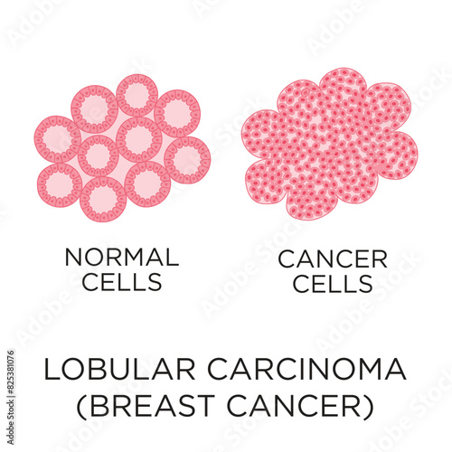 Lobular carcinoma (breast cancer) cells flat style vector illustration