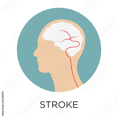 Ischemic or Hemorrhagic Brain stroke flat style vector illustration