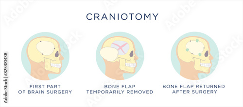 Craniotomy vector illustration showing step by step surgical procedure