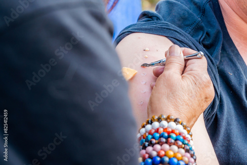 Kambo Ceremony: Marks on the Arm photo