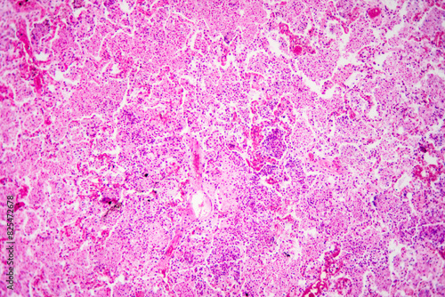 Micrograph of lobar pneumonia haemorrhagic edema period photo