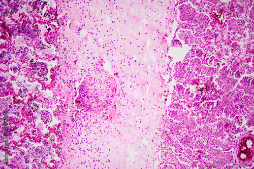 Micrograph of lobar pneumonia haemorrhagic edema period photo