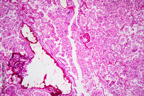 Micrograph of lobar pneumonia haemorrhagic edema period photo