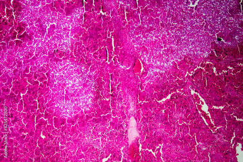 Micrograph of lobar pneumonia red hepatization stage photo