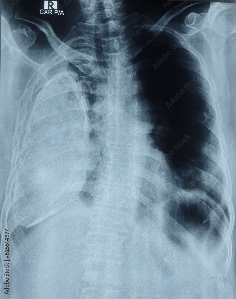 X ray of encysted pleural effusion, a rare disease condition X ray of encysted pleural effusion, a rare disease condition