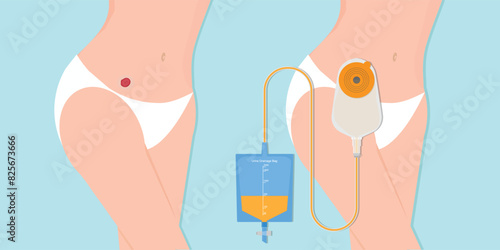 Stoma and colostomy isolated on background.