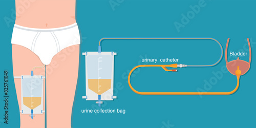 Urinary catheter in the male body with urinary leg bag.