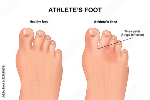 Athlete's foot vector illustration medical artwork
