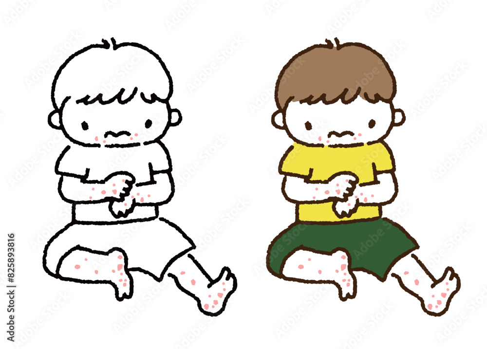 手足に出ている赤い発疹を気にする子供/Illustration of a child concerned about a red rash on his hands and feet 手足に出ている赤い発疹を気にする子供/Illustration of a child concerned about a red rash on his hands and feet