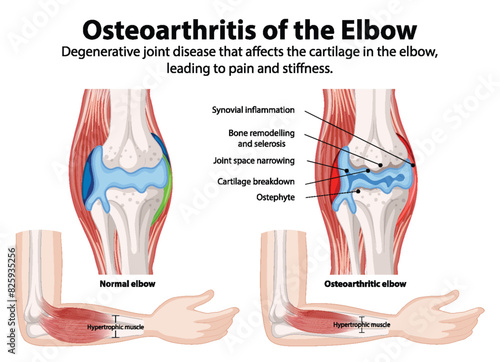 Comparison of normal and osteoarthritic elbow joints