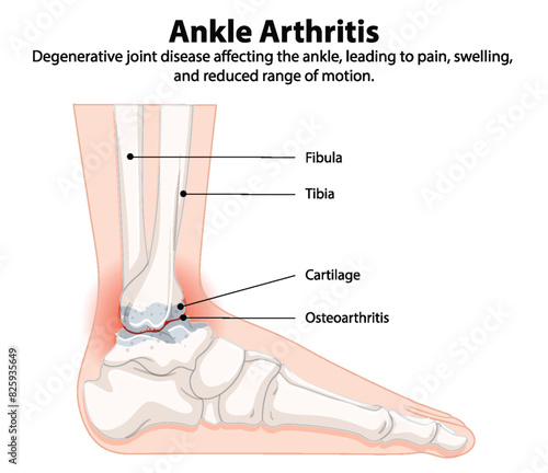 Detailed diagram of ankle arthritis and affected areas