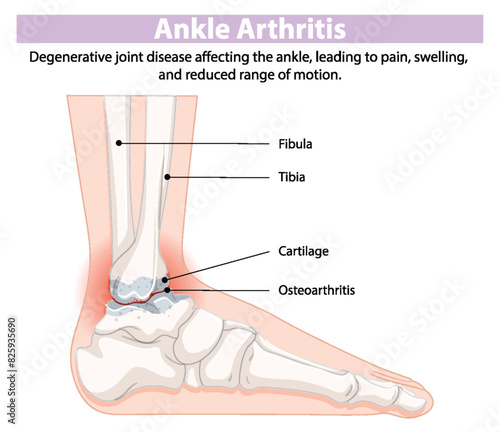 Diagram showing ankle arthritis and affected areas