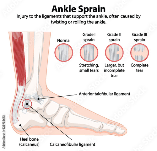 Detailed diagram of ankle sprain types