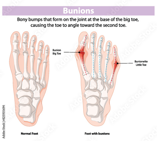 Illustration of normal foot and foot with bunions