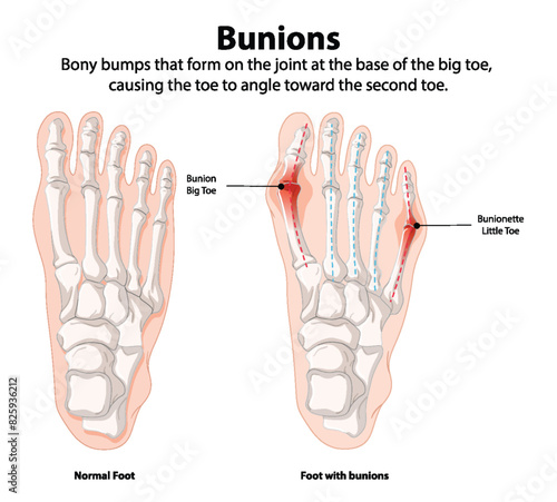 Comparison of normal foot and foot with bunions