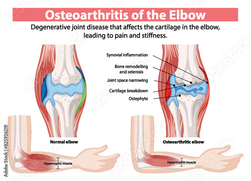 Degenerative joint disease causing pain and stiffness