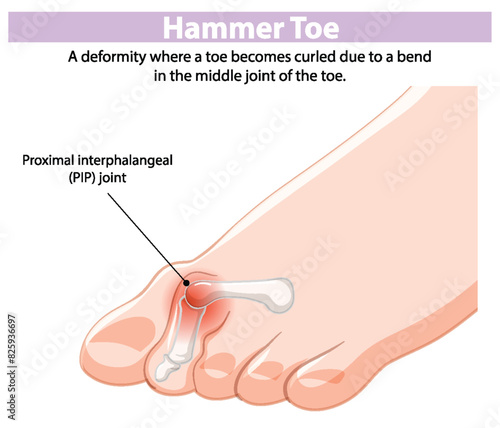 Depiction of hammer toe deformity and PIP joint