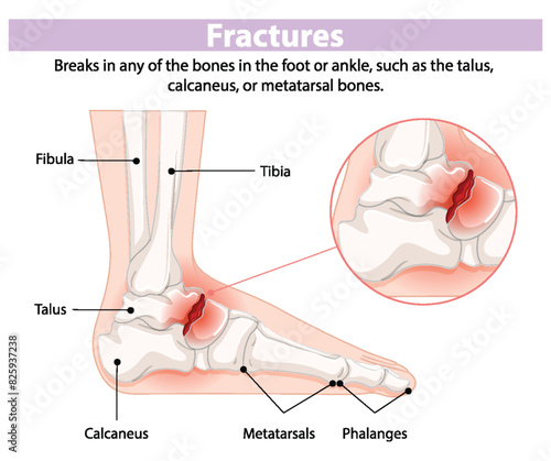 Illustration of foot and ankle bone fractures