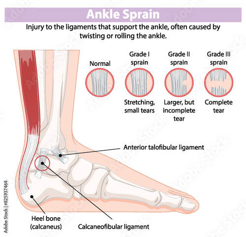 Illustration of ankle sprain grades and ligaments