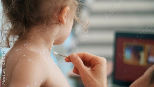 Mother treating her little daughter with varicella or chickenpox at home photo