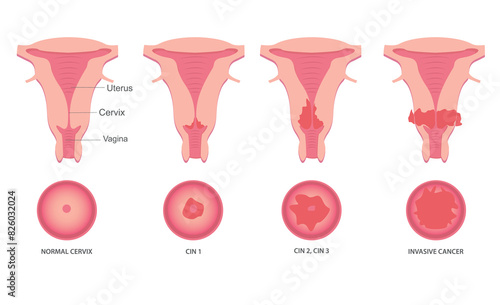 Set of Cervical invasive cancer intraepithelial neoplasia Dysplasia 1 2,3. Female reproductive system Carcinoma view. medical flat style
Biology, anatomy, medicine and healthcare scientific concept.  photo