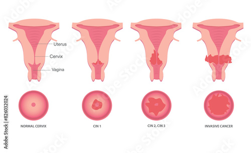 Set of Cervical invasive cancer intraepithelial neoplasia Dysplasia 1 2,3. Female reproductive system Carcinoma view. medical flat style
Biology, anatomy, medicine and healthcare scientific concept. 