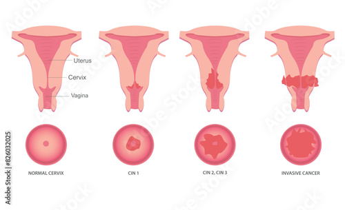 Set of Cervical invasive cancer intraepithelial neoplasia Dysplasia 1 2,3. Female reproductive system Carcinoma view. medical flat style
Biology, anatomy, medicine and healthcare scientific concept. 
