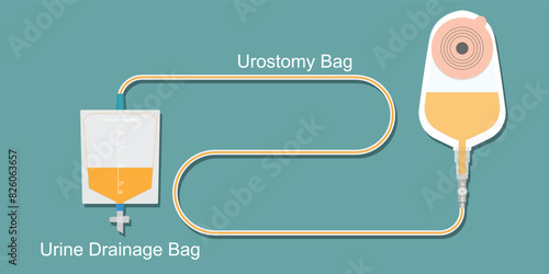 Urostomy bag and urine drainage bag.