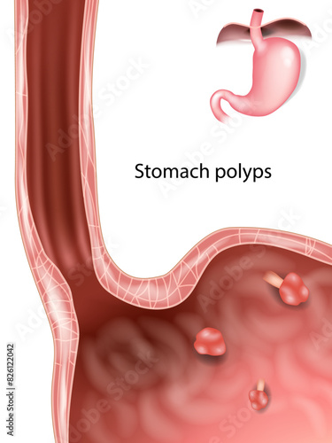 Polyps in Stomach. Gastric polyp. Medical illustration of stomach