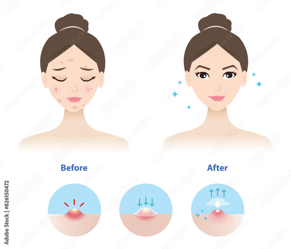 Comparison of woman face before and after use acne pimple patch for inflammatory acne vector illustration on white background. Icon set of direction for use acne patch absorbing pustule on skin face. Comparison of woman face before and after use acne pimple patch for inflammatory acne vector illustration on white background. Icon set of direction for use acne patch absorbing pustule on skin face.