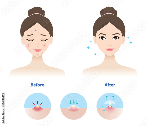 Comparison of woman face before and after use acne pimple patch for inflammatory acne vector illustration on white background. Icon set of direction for use acne patch absorbing pustule on skin face.